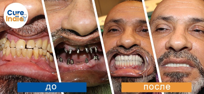 зубной имплант - имплантация зубов в индии